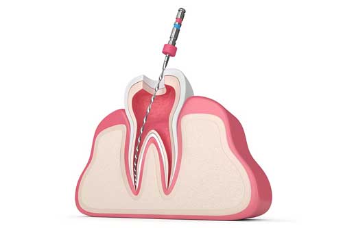 Endodoncia